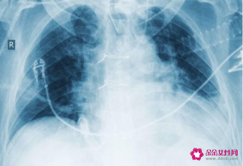 得了新冠肺炎的后遗症