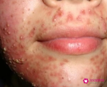 粉刺是什么样子图片