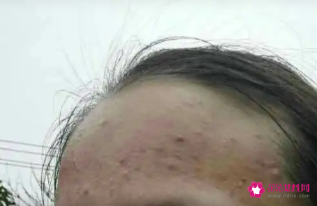 怎么去额头闭口去额头闭口7个小妙招