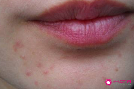 嘴唇上面长痘痘的原因
