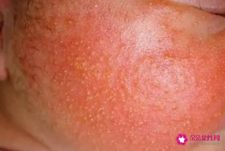 新生儿脸上有湿疹怎么护理比较好