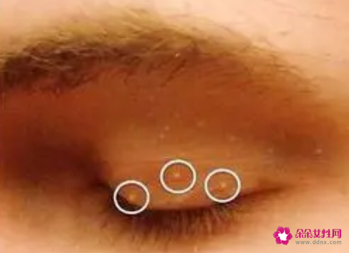 脂肪粒怎么去除小窍门有哪些