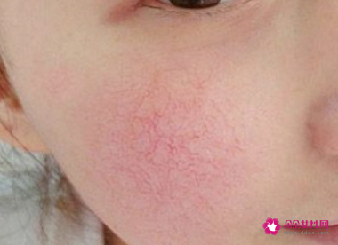 怎么去脸上红血丝最有效