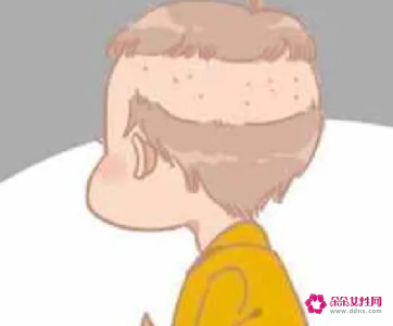 枕秃的预防方法