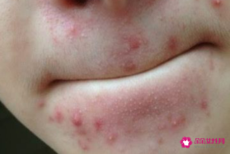 嘴唇上面长痘痘的原因