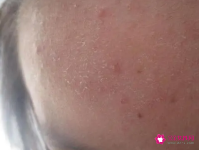 冬天身体皮肤干燥怎么改善