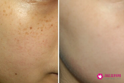 色素斑立清乳霜真的能祛斑吗