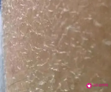 皮肤干燥皮屑多怎么办