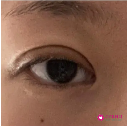 全切双眼皮眼头宽眼尾窄了
