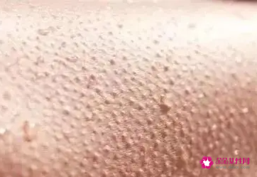 皮肤干燥皮屑多怎么办