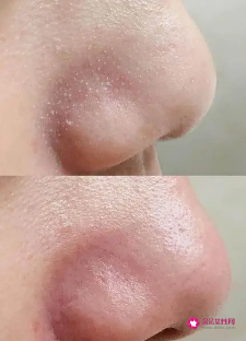 怎样可以去除黑头