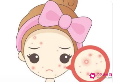 针对不同时期肌肤的祛痘攻略