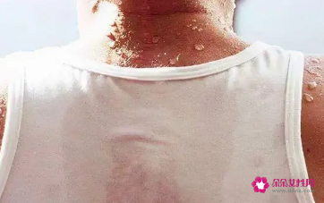 运动出汗擦干好还是自然干