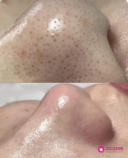 怎样可以去除黑头