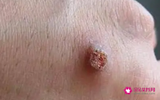 什么方法可以去瘊子