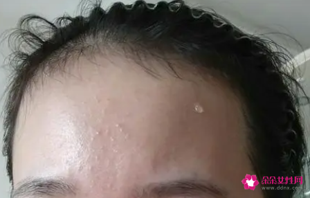 怎么去额头闭口去额头闭口7个小妙招