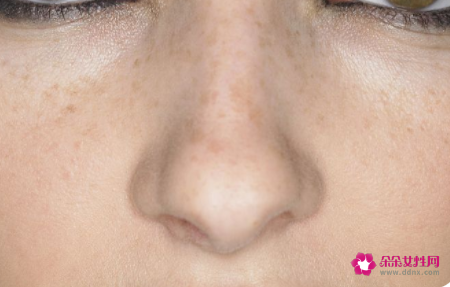 面部皮肤堵塞黑色素不能代谢怎么办