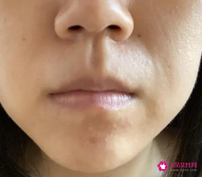 为什么法令纹一边明显一边没有