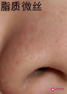 怎样可以去除黑头