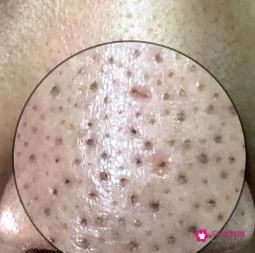 毛孔粗大是什么原因形成的