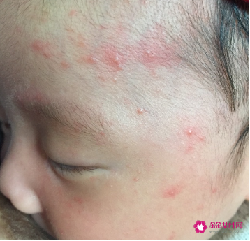 新生儿脸上有小红点怎么办