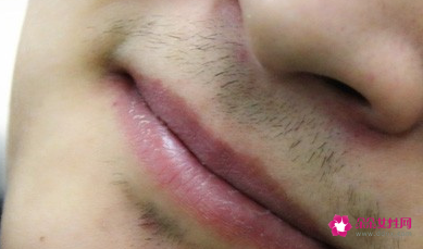 女生长胡子怎么永久去除