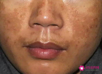 脸上色素沉着能祛除吗