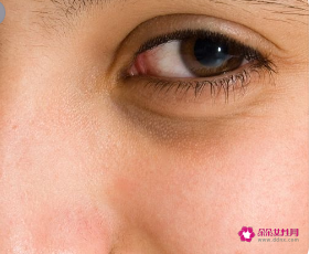 有泪沟怎么办怎么改善