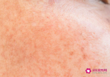 小粉刺怎么清除