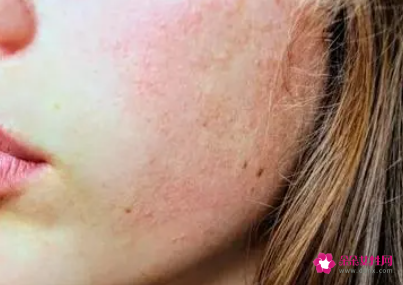 敏感肌护肤步骤