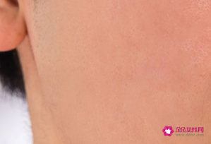 色素沉着时间久了可以去除