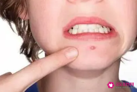 嘴唇上面长痘痘的原因