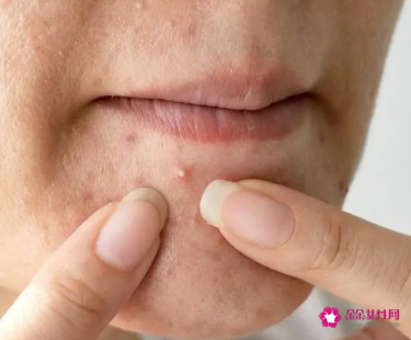 有白色脓液的痘痘是什么痘