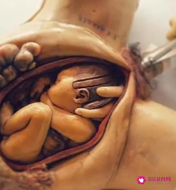 顺产挤压头骨变形