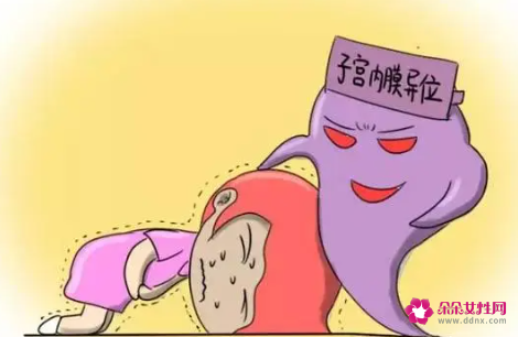 子宫内膜异位症有哪些症状