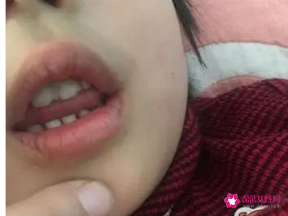 宝宝腺样体肥大有什么危害