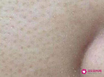 毛孔里面挤出的白色细条