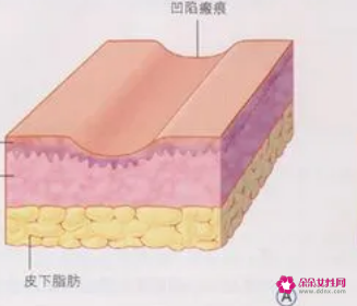 疤痕粘连凹陷怎么处理