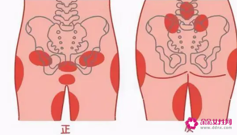 耻骨联合分离怎么办