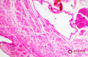 女性念珠菌感染早期症状