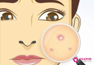青春痘怎么调理好