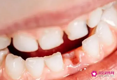 梦见牙齿全部掉光好不好