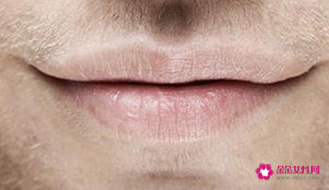 嘴上太干起皮怎么办