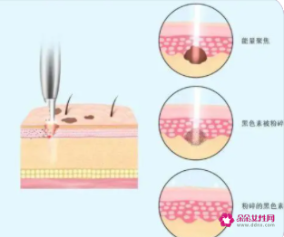 皮秒一定要做2～3次吗