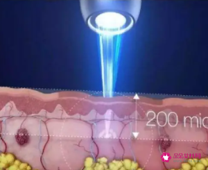 皮秒一定要做2～3次吗