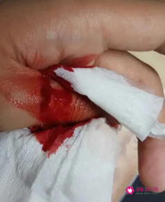 手指割伤晚上剧烈疼痛