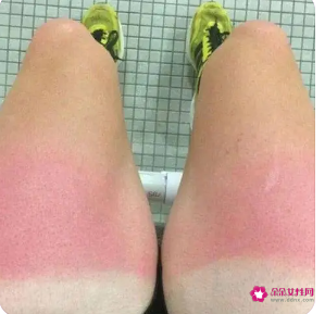 晒伤发痒擦什么止痒