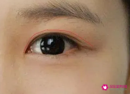 内双的人是眼皮松弛吗