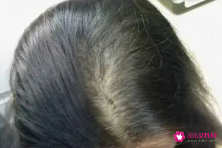 怎么可以刺激毛囊长头发