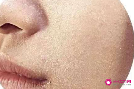 电脑族皮肤干燥的护肤方法